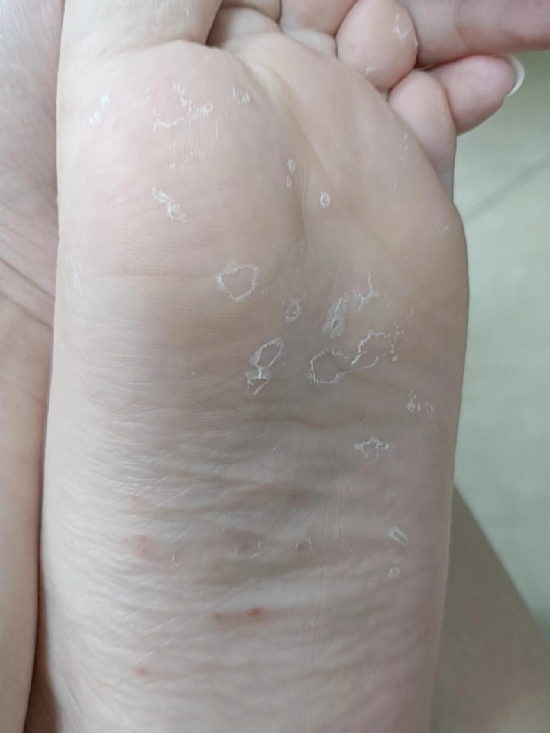 脚上长小水泡是怎么回事