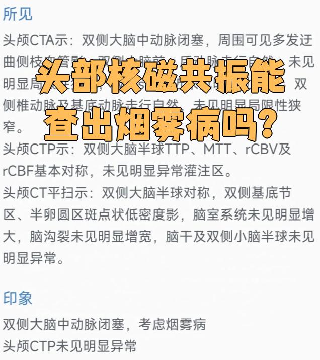烟雾病会遗传吗