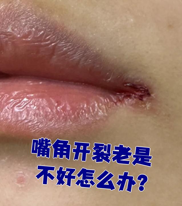 嘴唇裂开是什么原因?