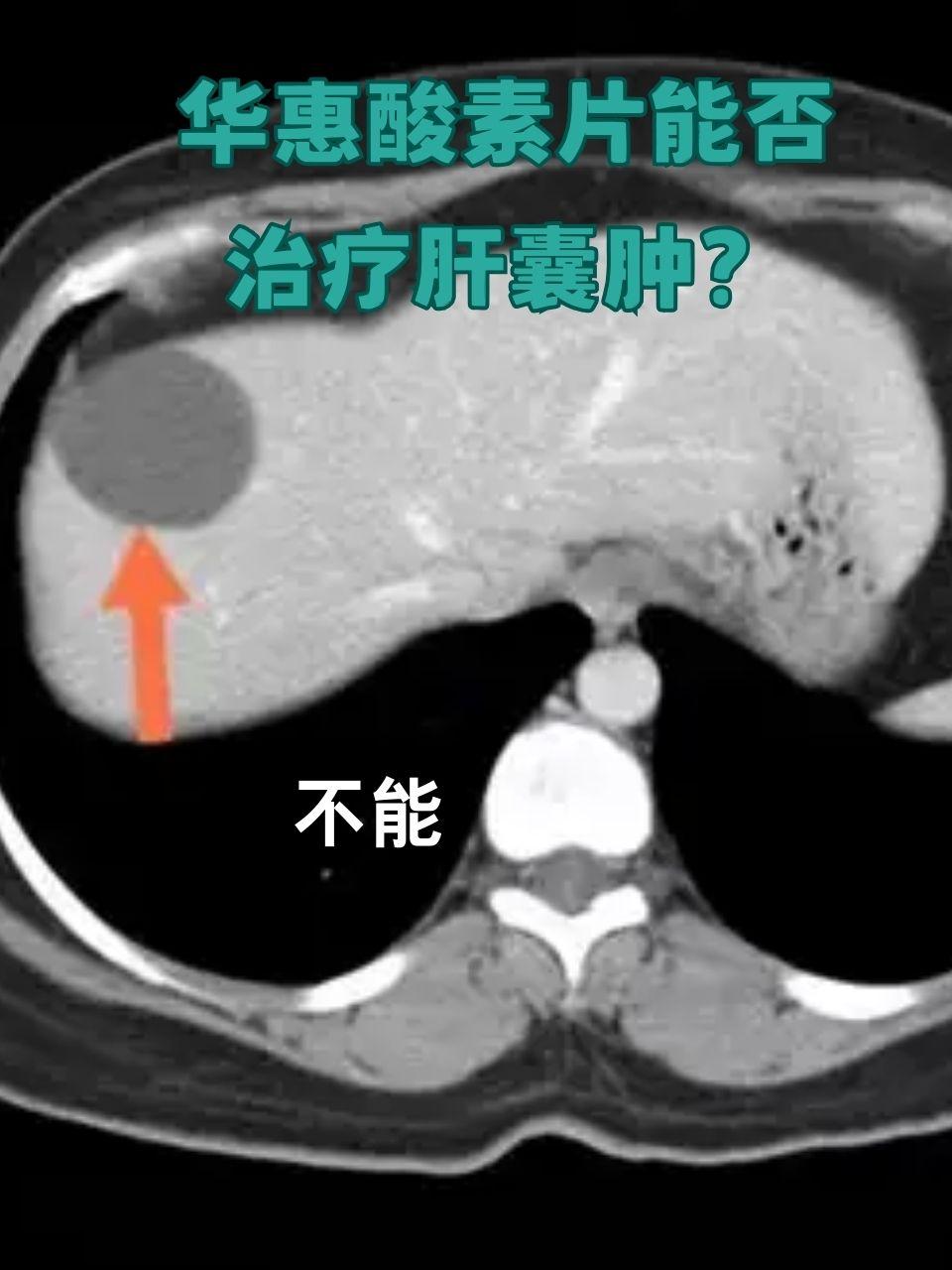 肝里有囊肿,严重吗?