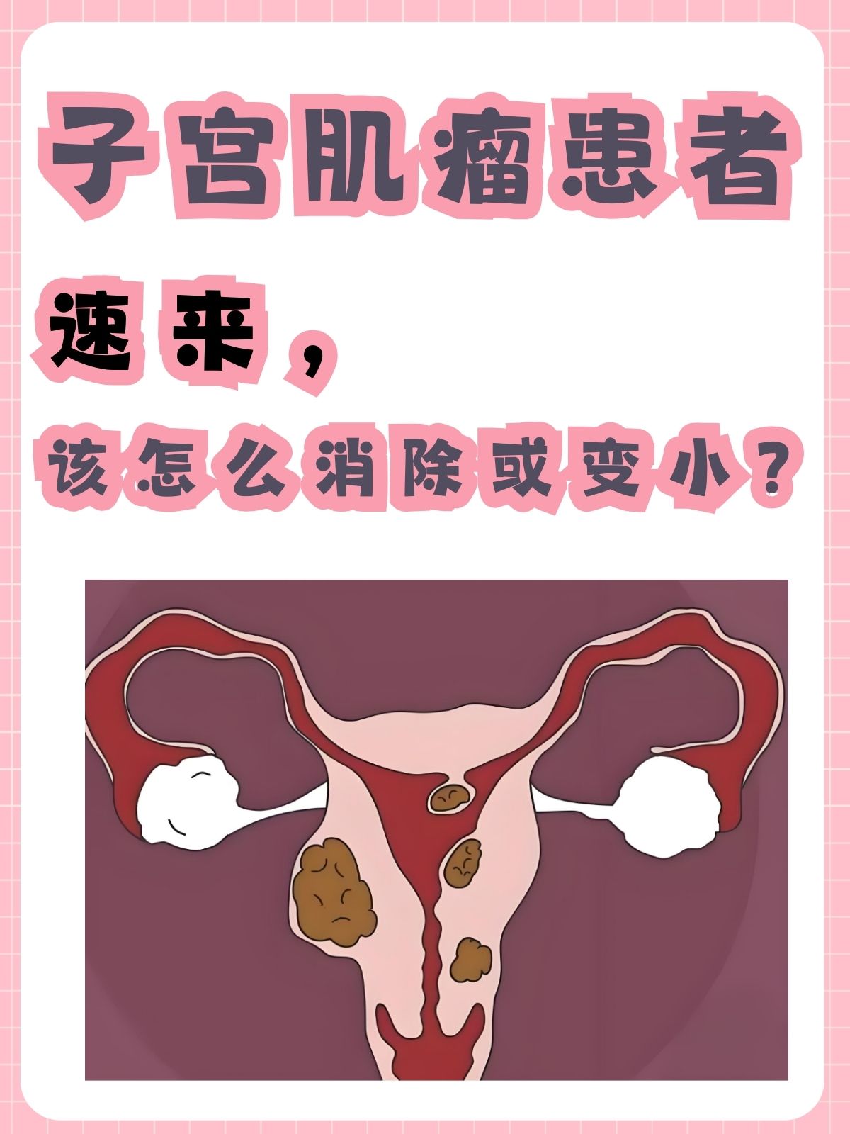 子宫肌瘤严重吗