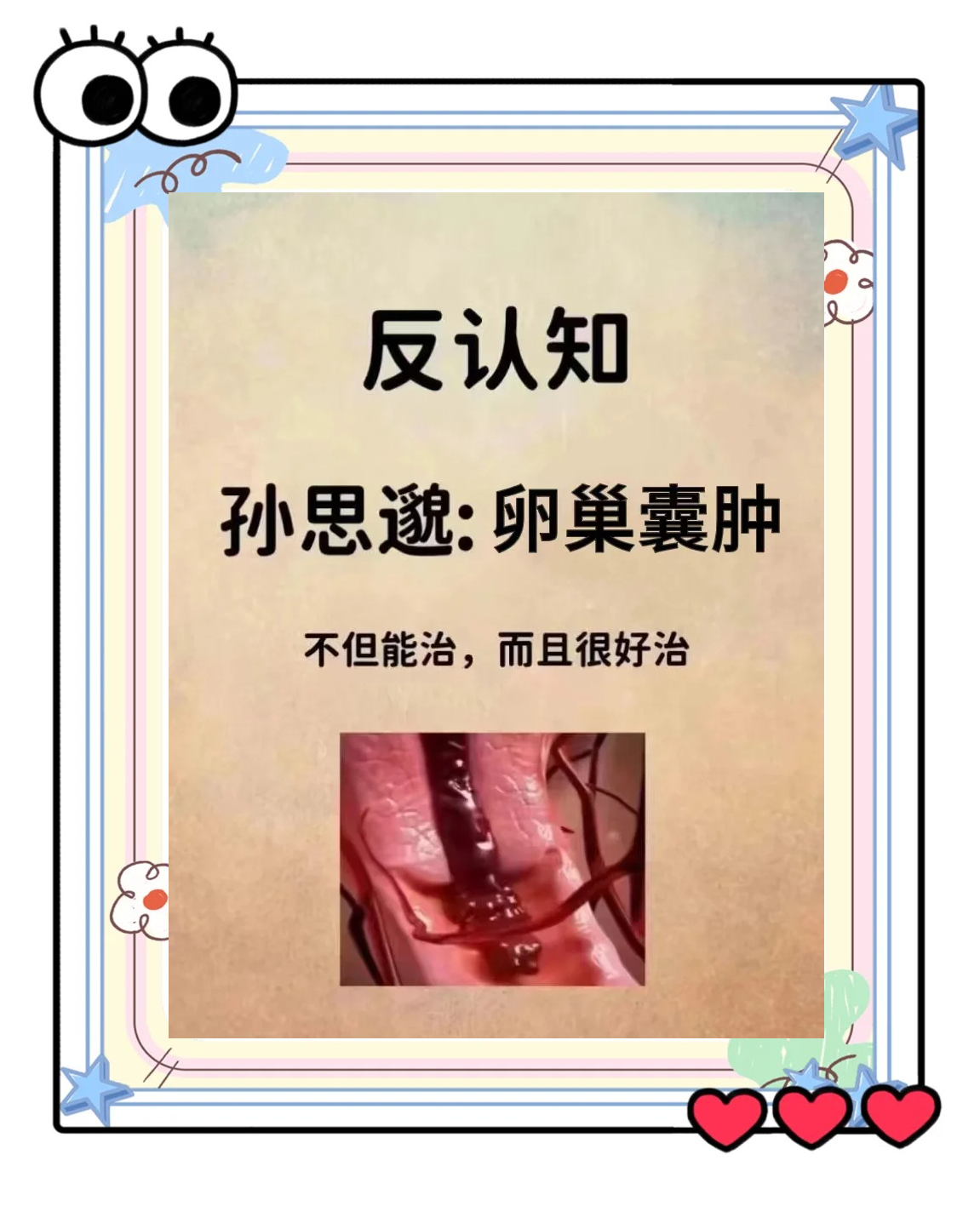 右侧附件囊肿怎么治疗?