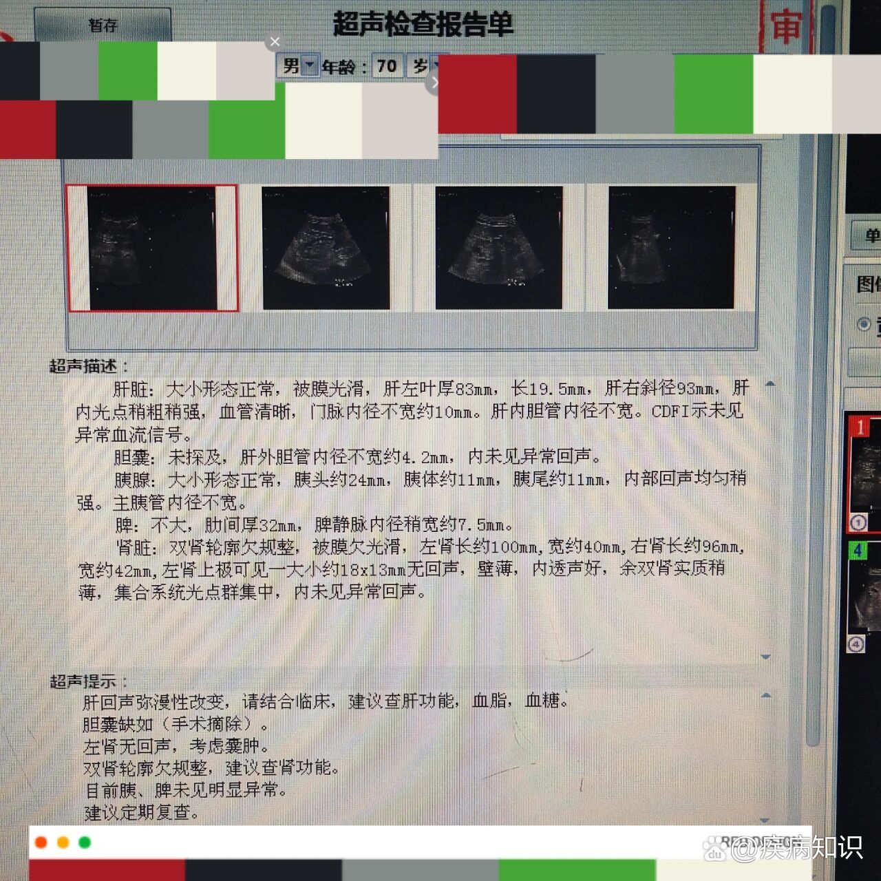 cdfi可见血流信号是什么意思