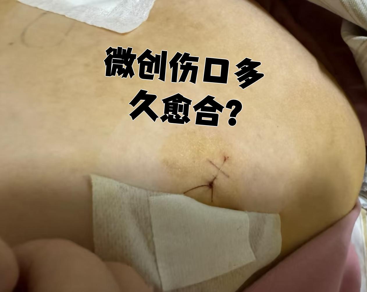 手术线头在肉里怎么办