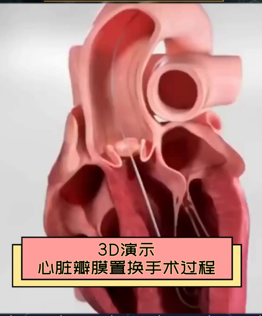 心脏换瓣后有后遗症吗