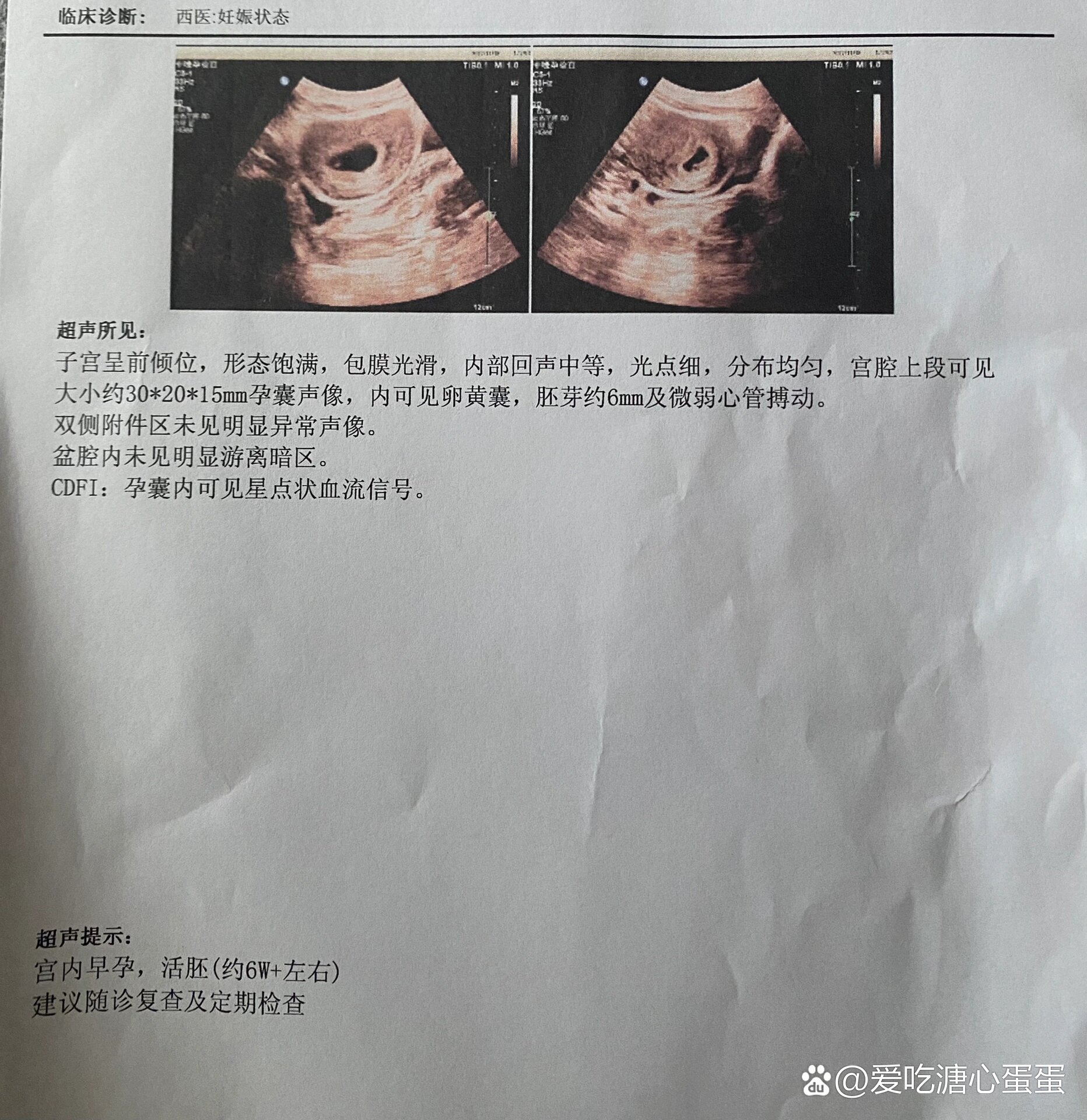 胎心146是男孩吗