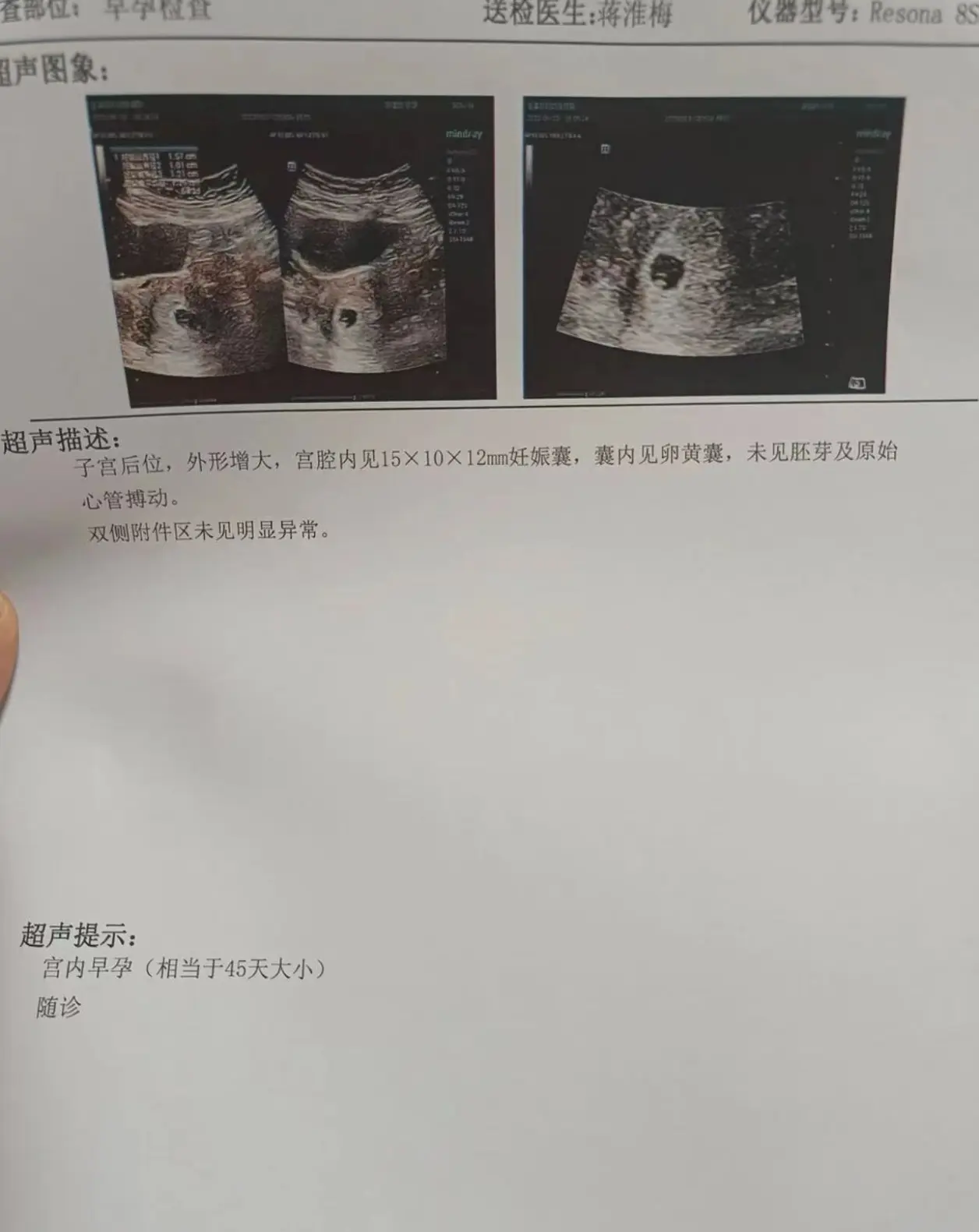 药物打胎的最佳时间