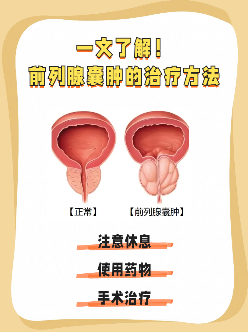 前列腺囊肿有什么症状表现