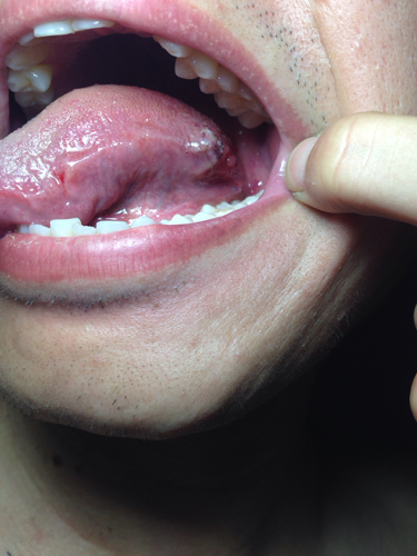 舌根淋巴滤泡增生是什么?