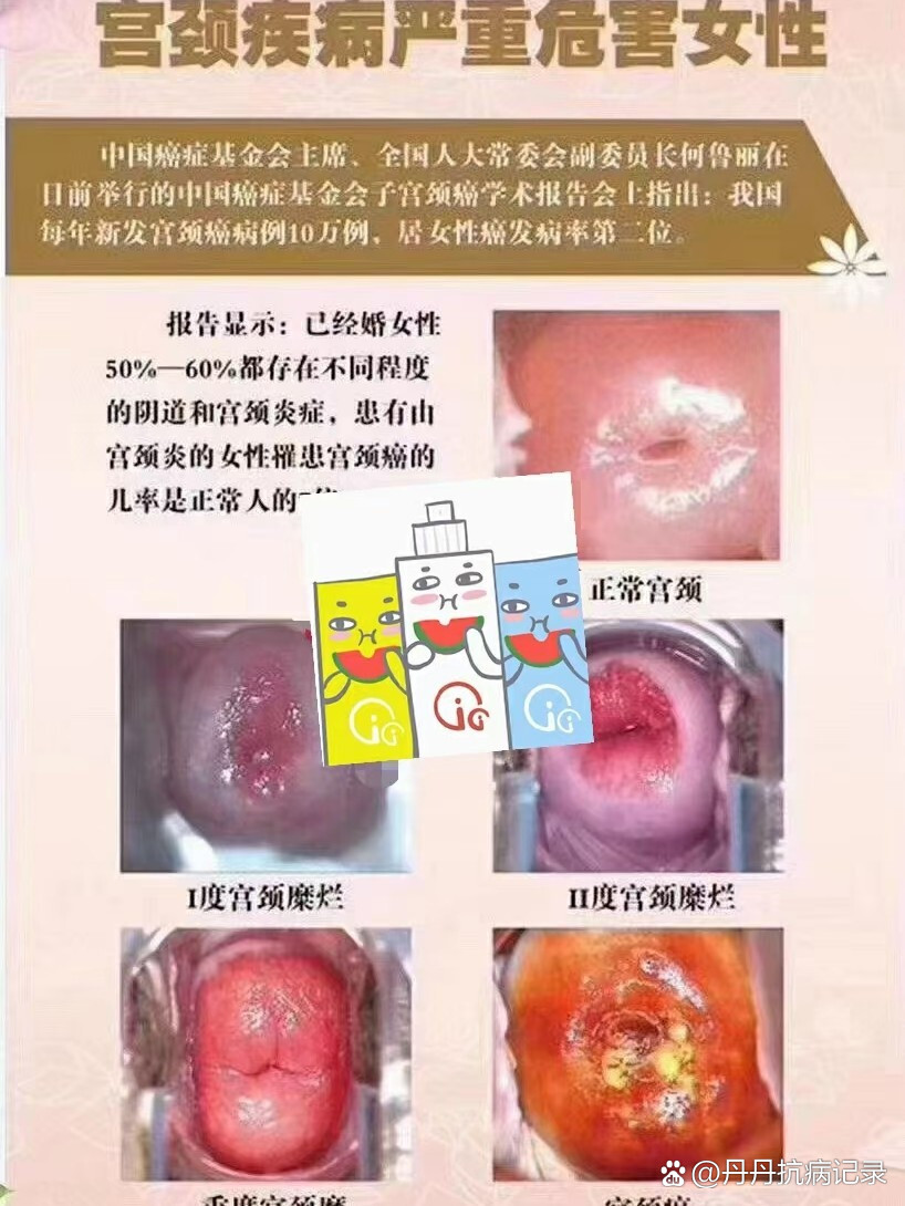 宫颈糜烂是怎么引起的