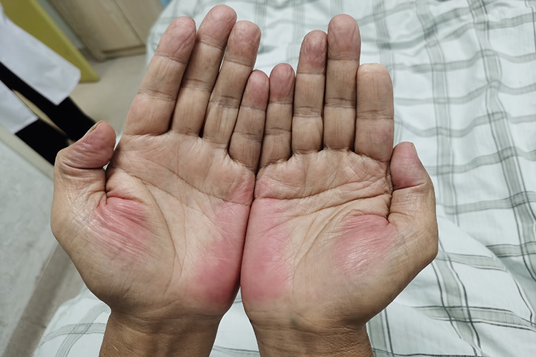 肝掌的治疗方法是什么