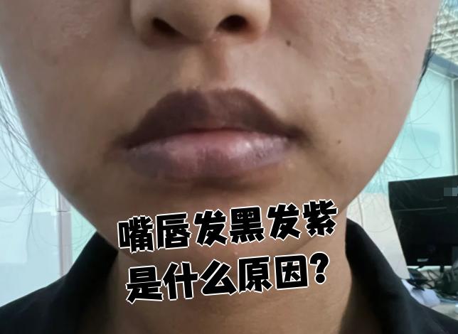 嘴唇发黑紫是什么原因