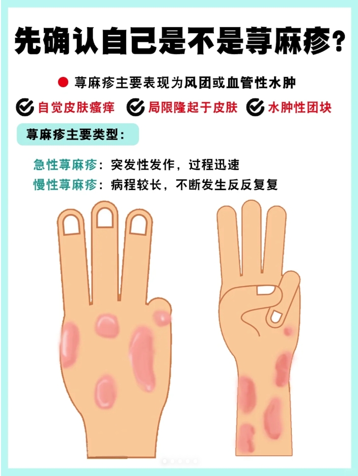 压迫性荨麻疹怎么治疗