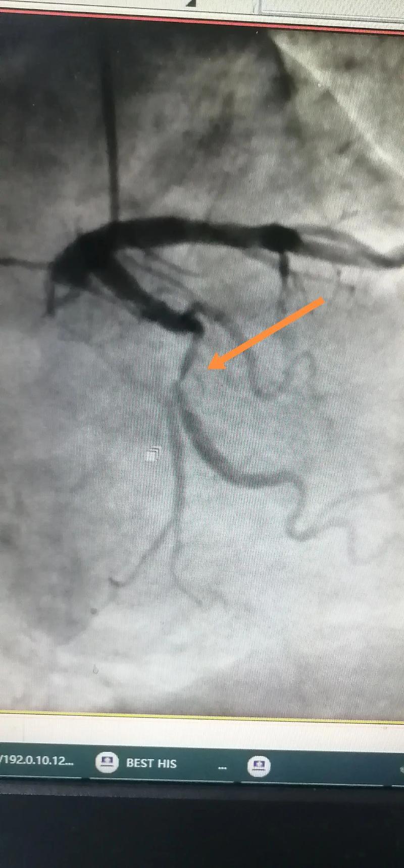 做冠状动脉造影危险吗