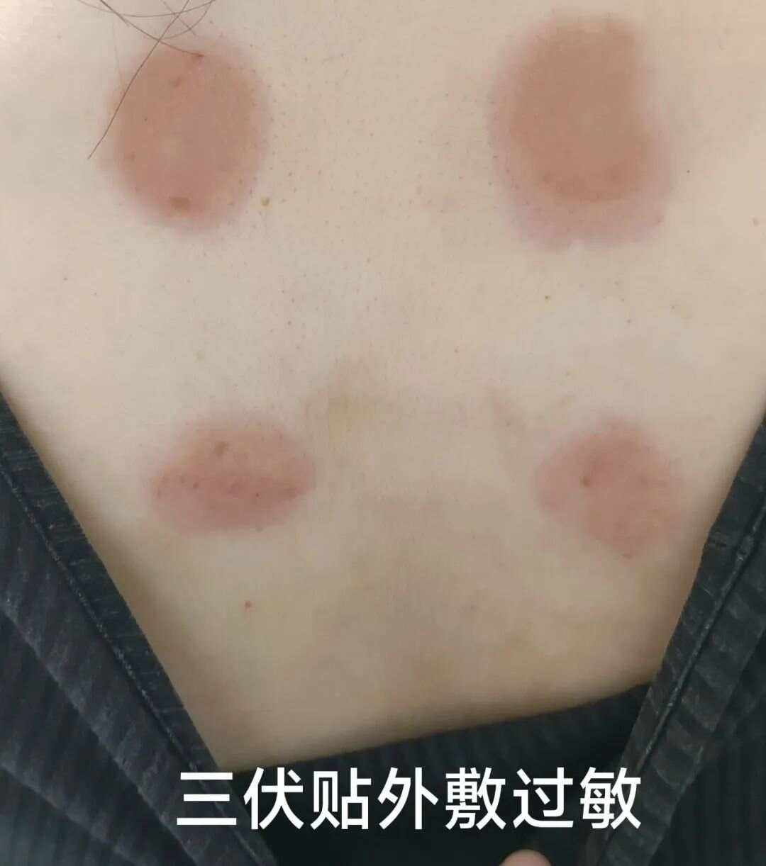 接触性皮炎的症状