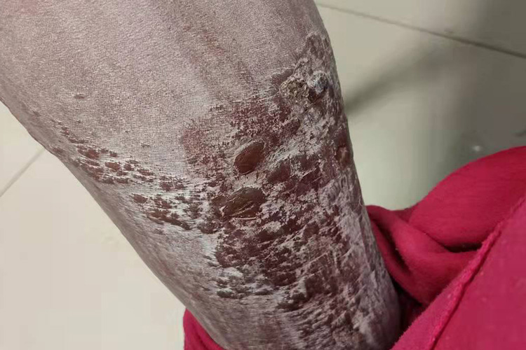 接触性皮炎的症状