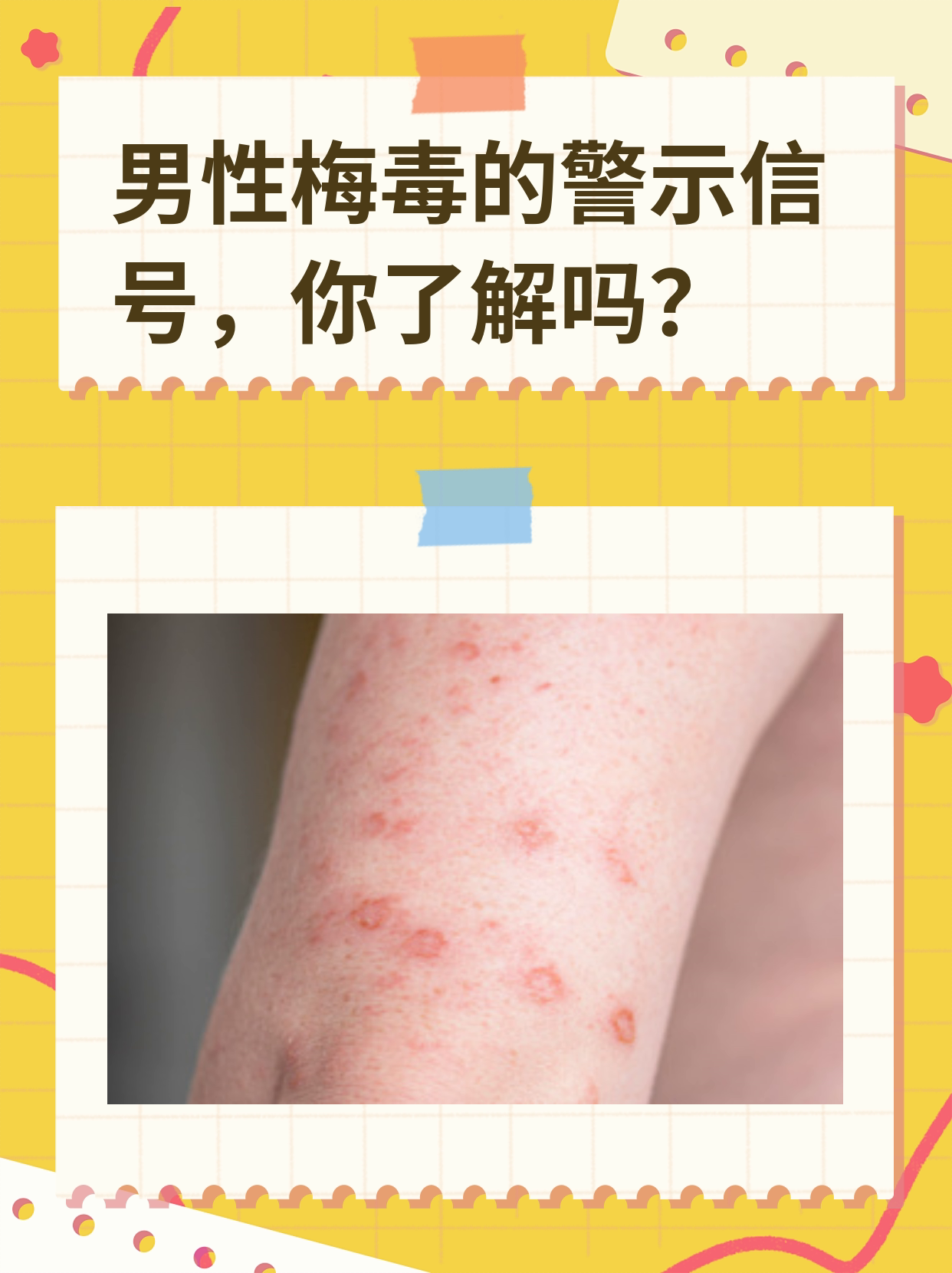 硬下疳是什么样的??