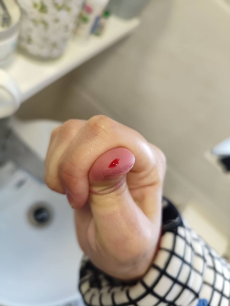 被仓鼠咬了需要打针吗?