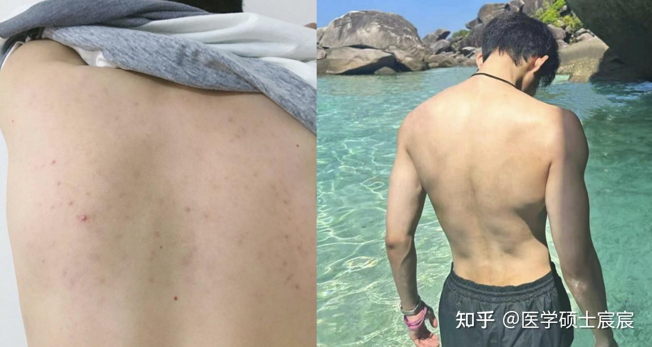 身上有虫子爬的感觉