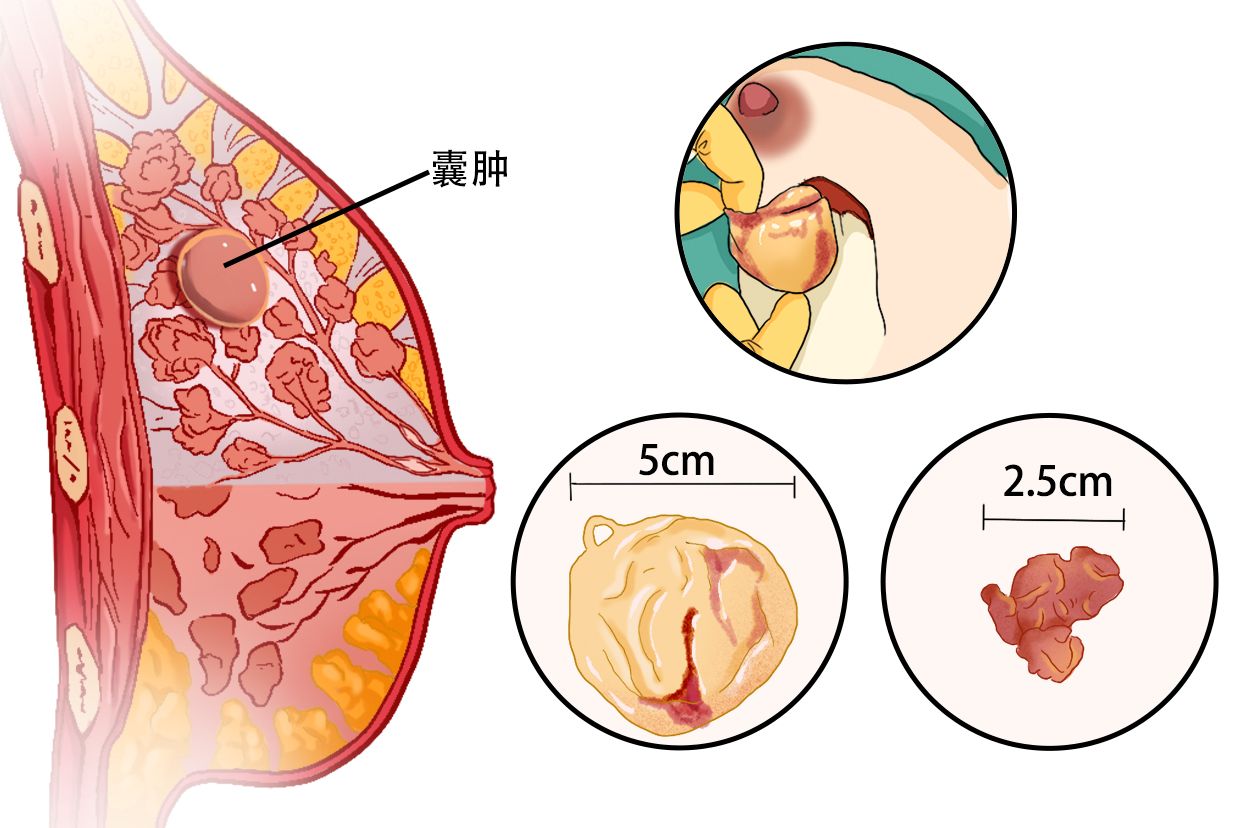乳腺囊肿是什么?