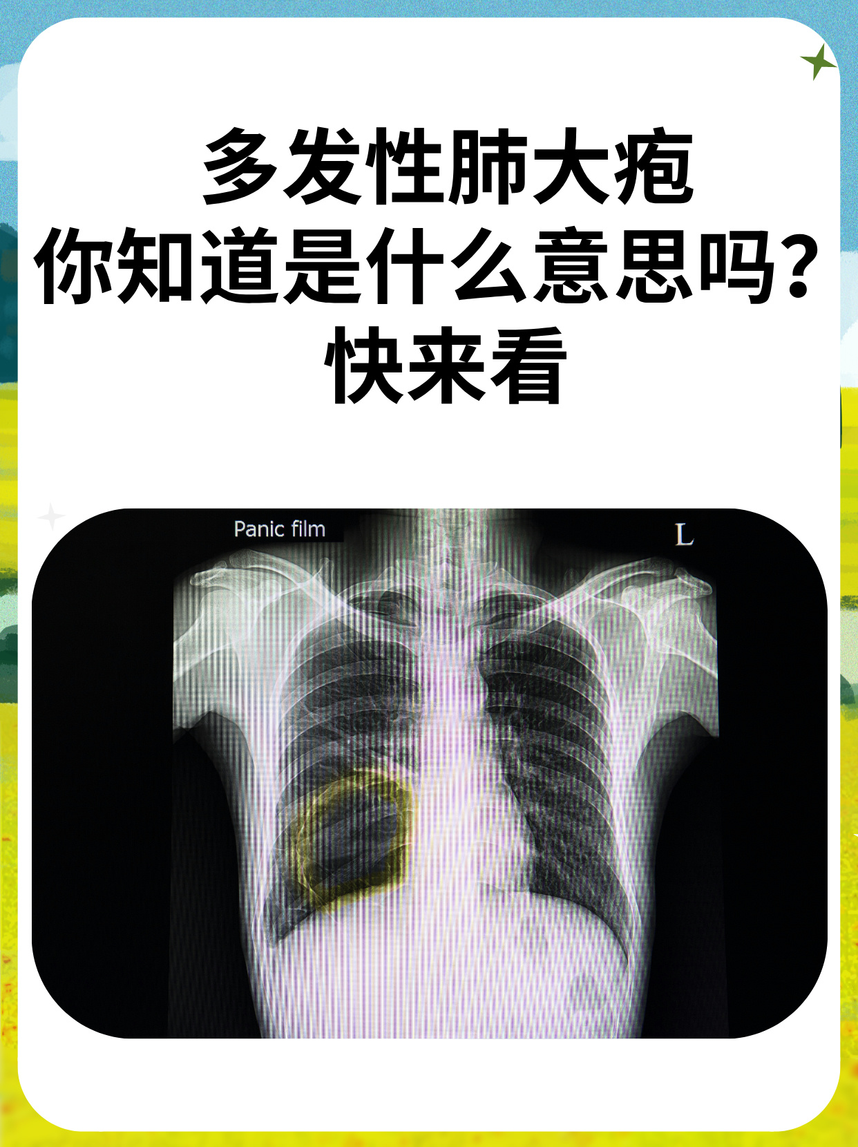 肺大泡有什么症状