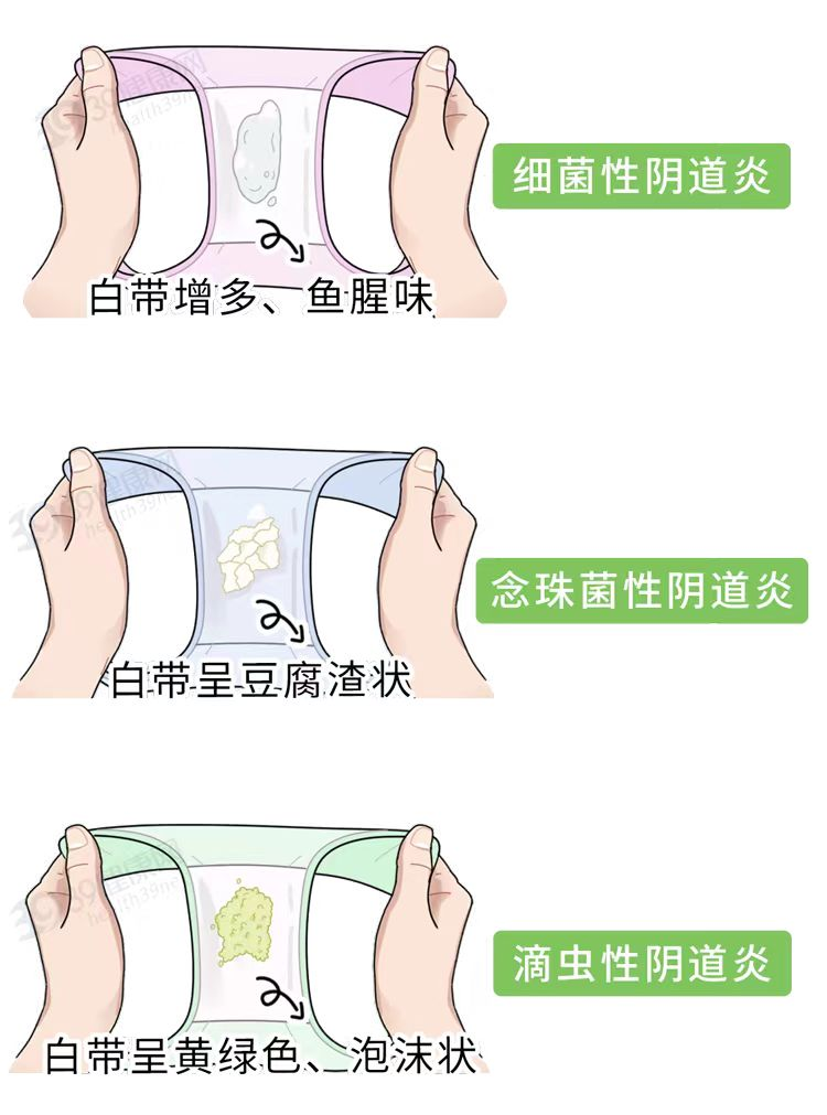 外阴阴道假丝酵母菌病怎么治