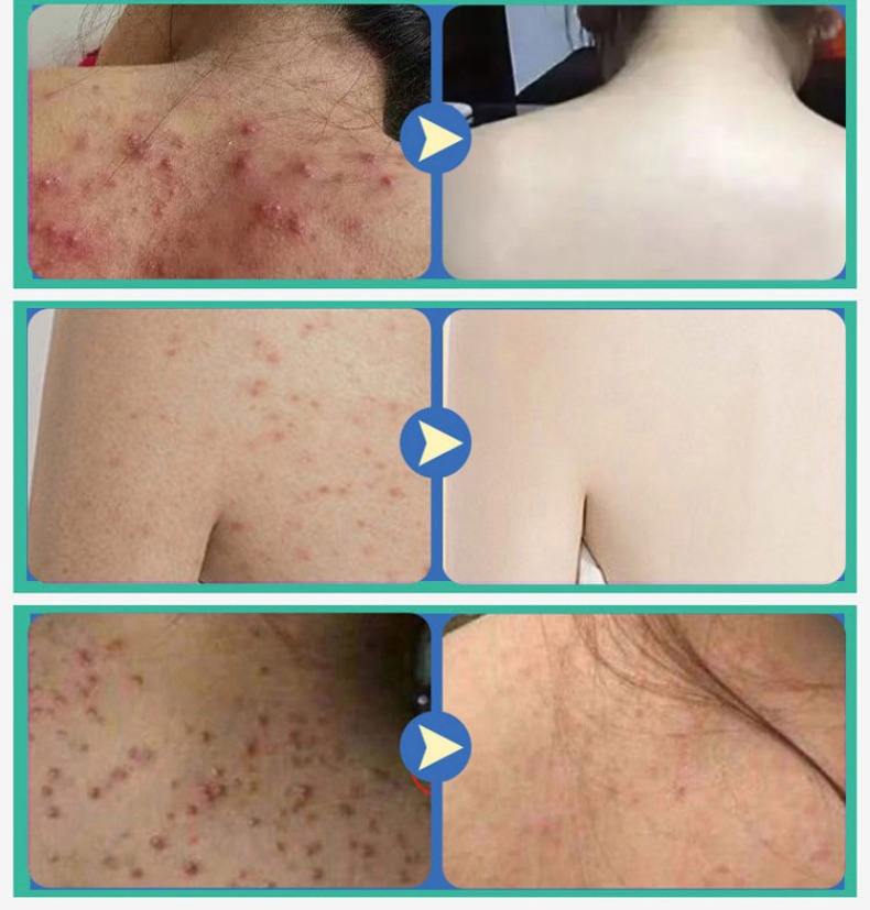 背后起痘痘如何清除