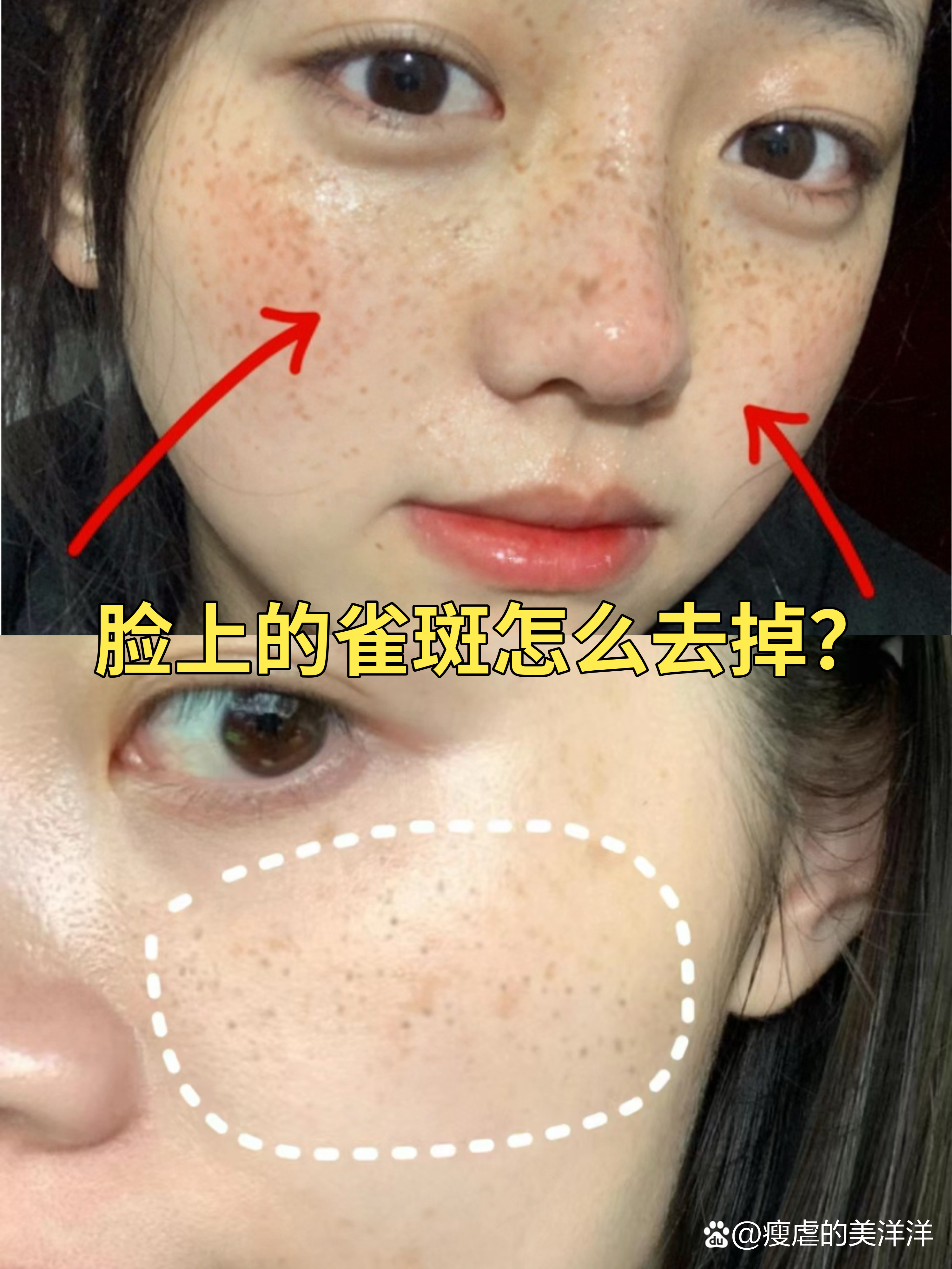 雀斑怎么治疗