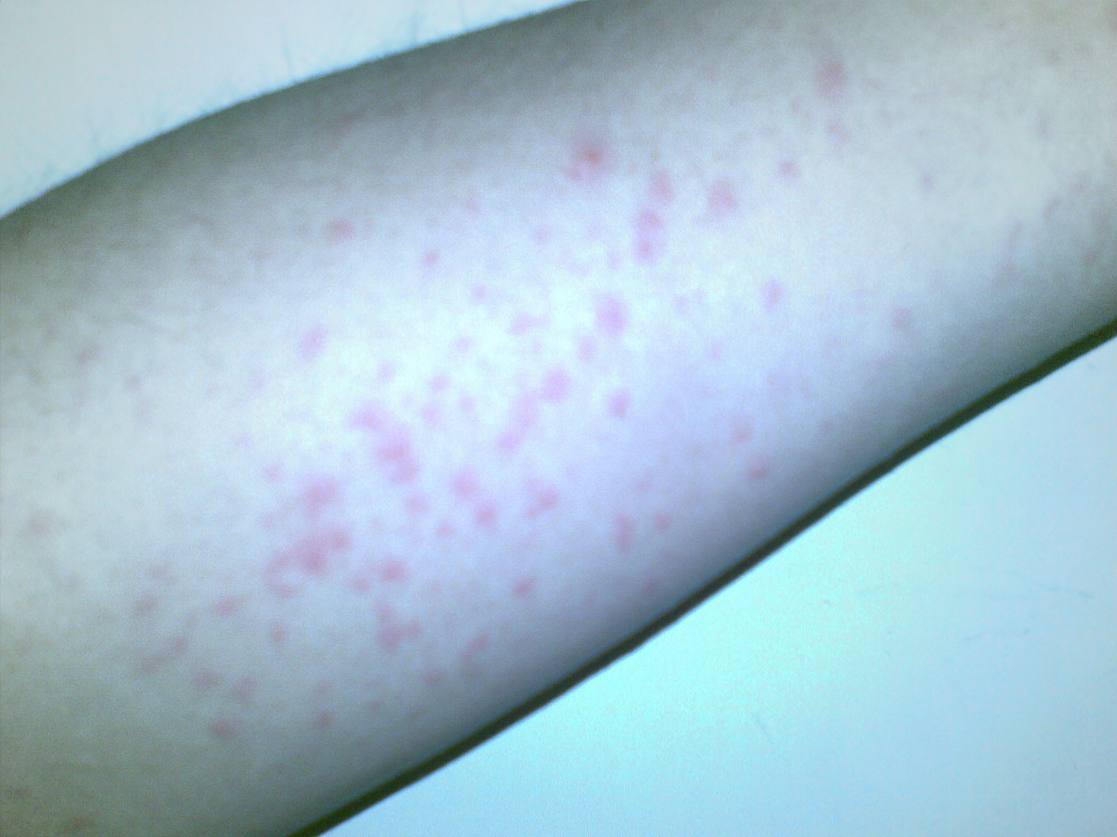 药物过敏反应有哪些典型症状