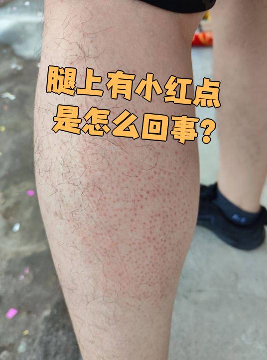 腿上有小红点怎么办