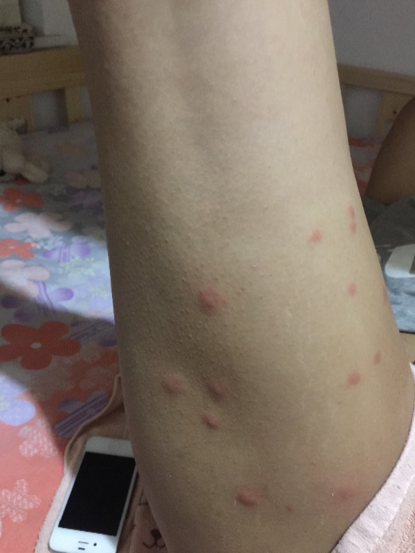 身上长出很多类似蚊子咬的包