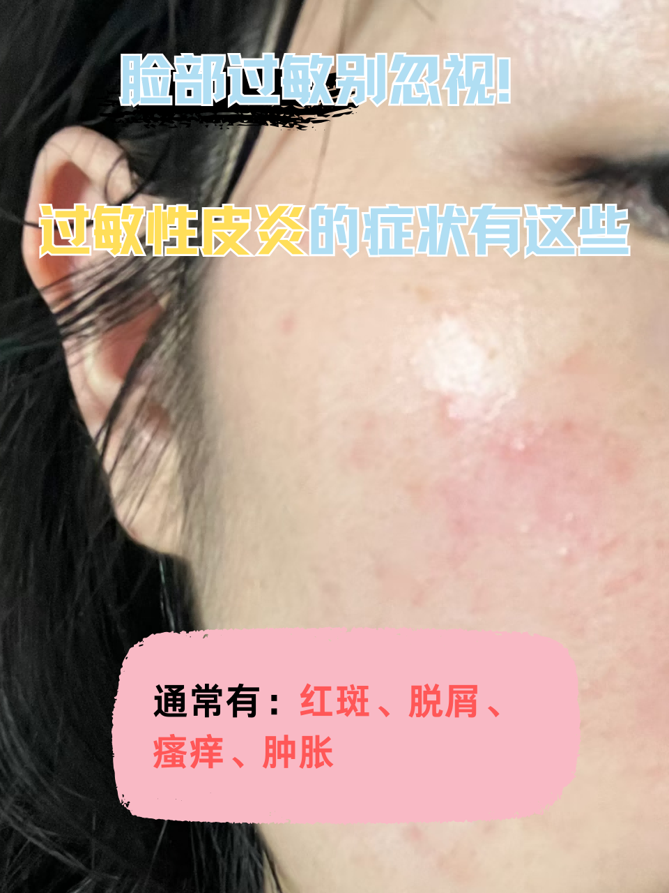 脸部过敏的症状表现有哪些