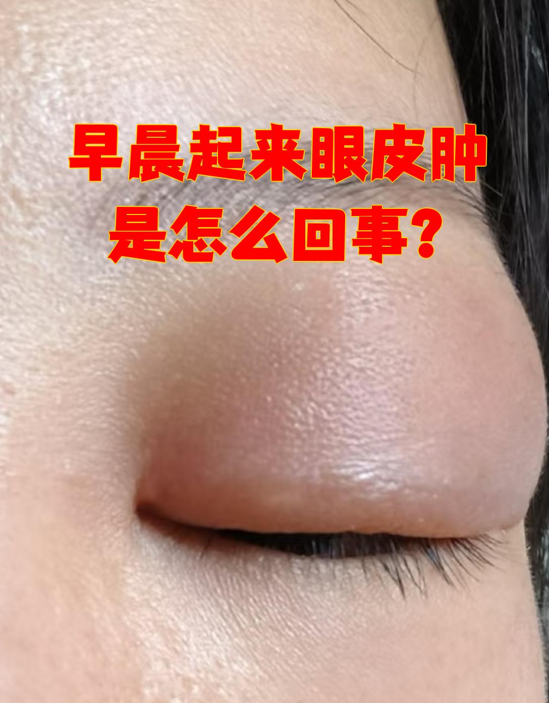 上眼皮红肿是怎么回事,