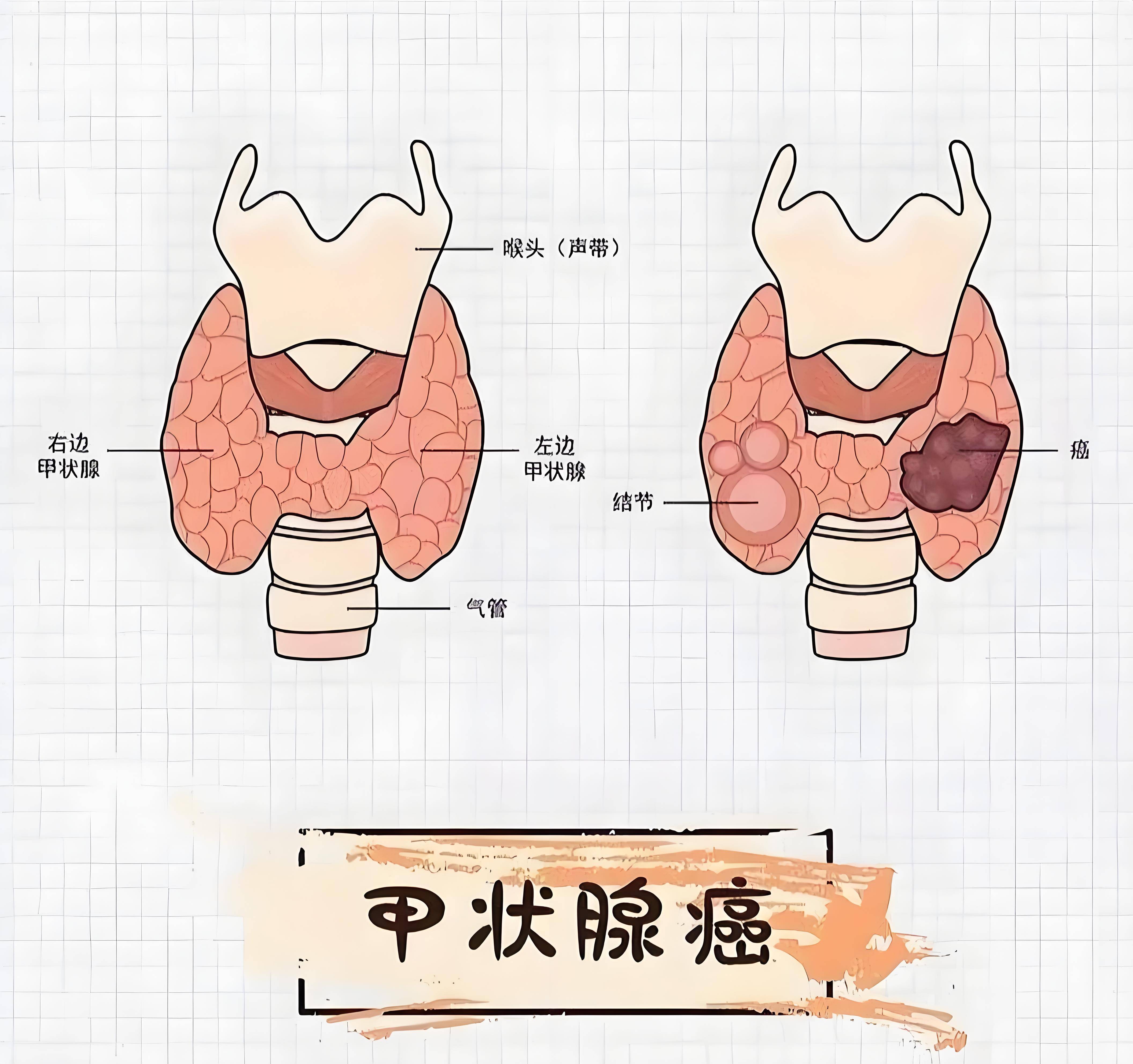 甲状腺疾病是什么病
