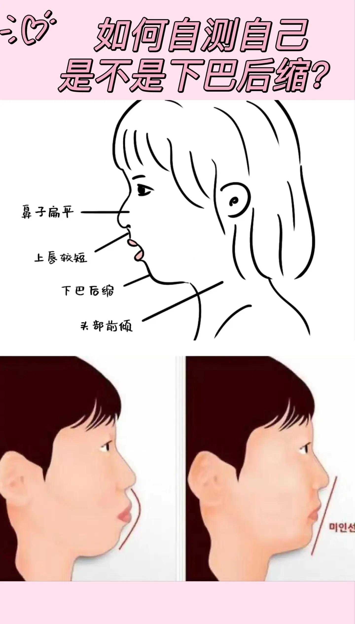 怎么才能让自己的下巴变长