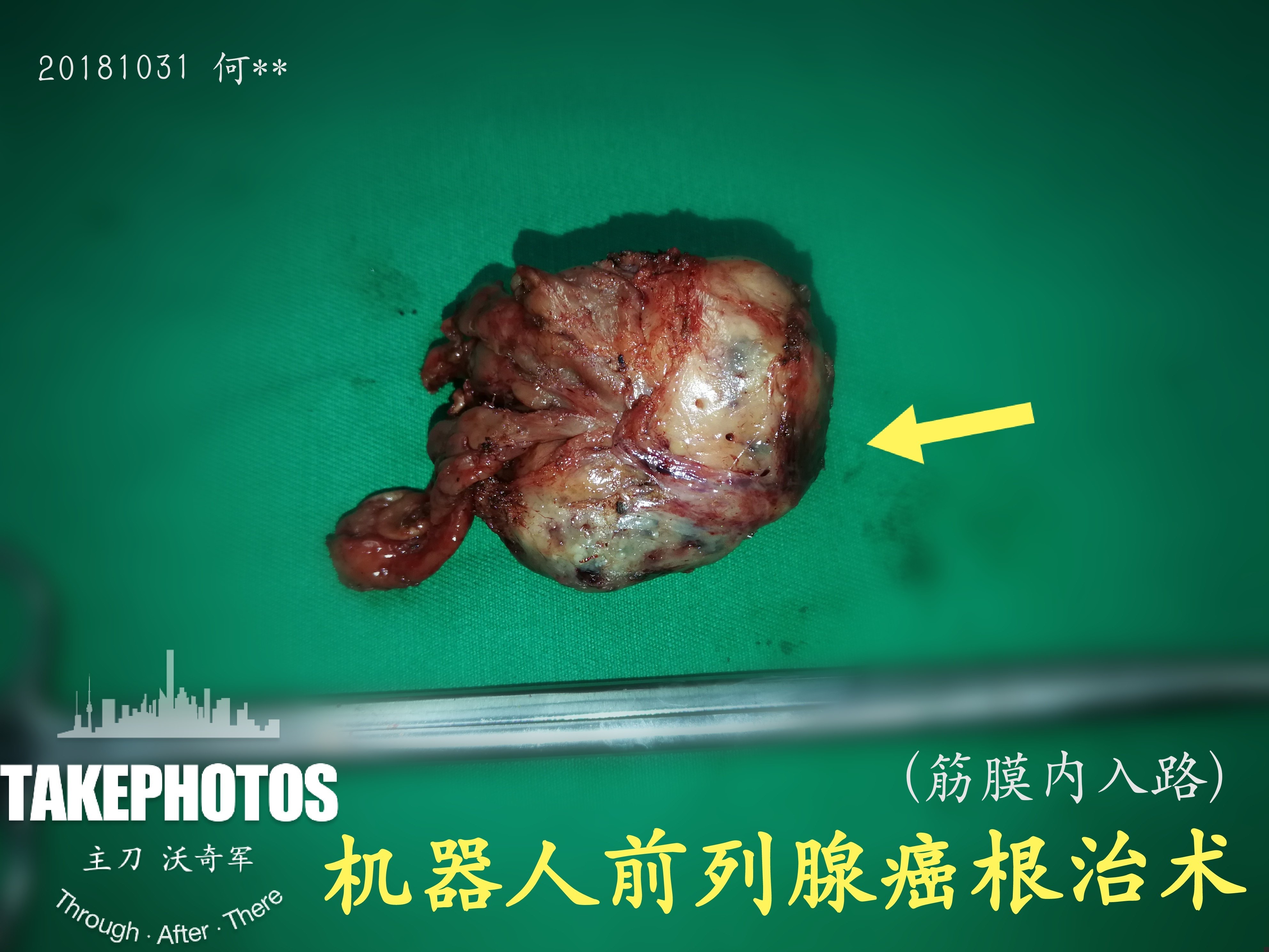 前列腺癌的晚期症状有哪些?