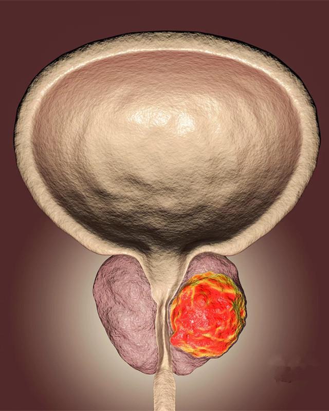 前列腺癌的晚期症状有哪些?