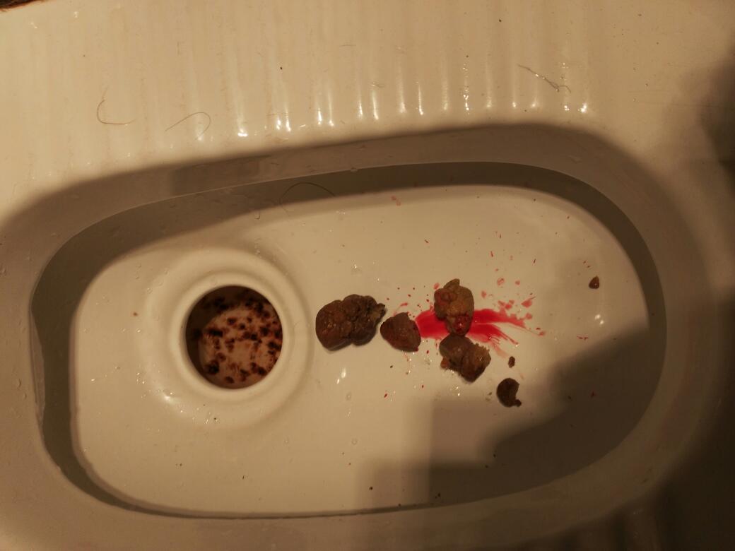 女生大便时出血严重吗