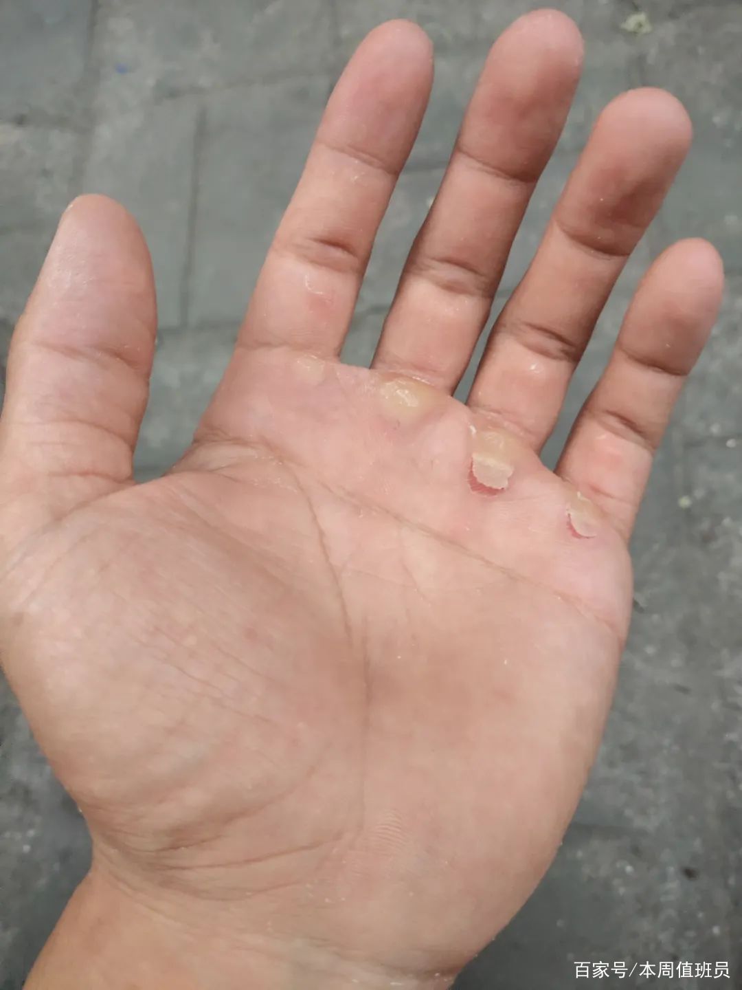 手上有茧子,怎么快速去除?