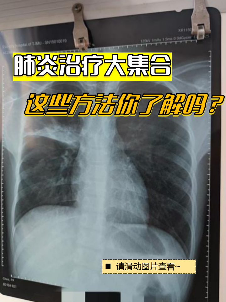 肺炎严重会怎么样