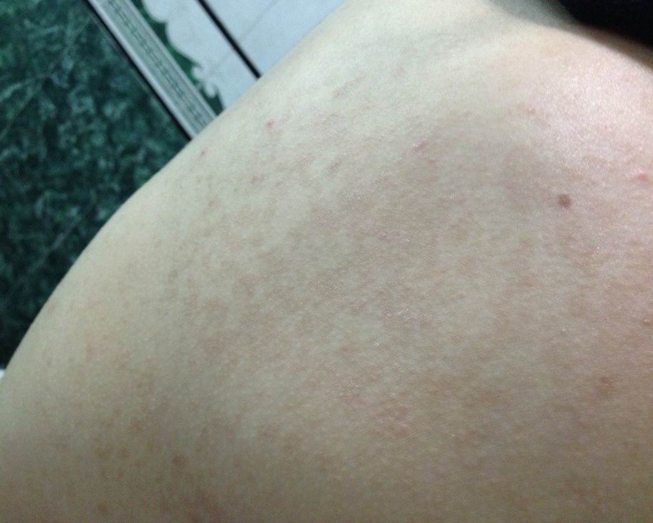 身上有深褐色斑点不疼不痒