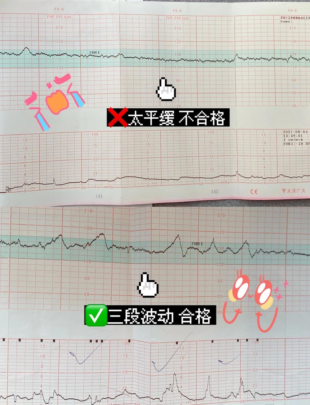 胎心监护要做多长时间