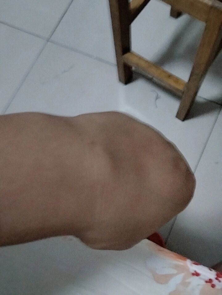 肉里面突然长了个硬疙瘩
