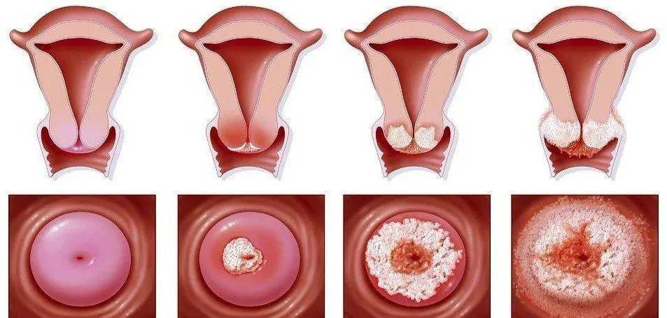 怎么治疗霉菌性阴道炎
