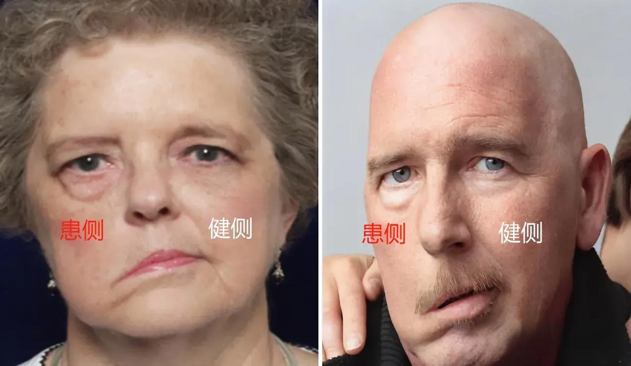 脸中风嘴歪了怎么办