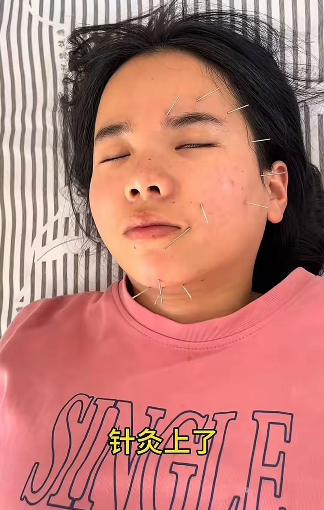 脸中风嘴歪了怎么办