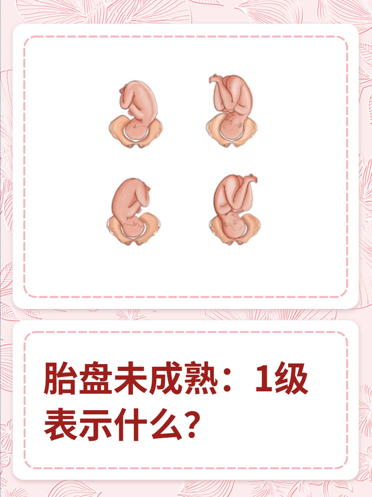 胎盘2级加是什么意思
