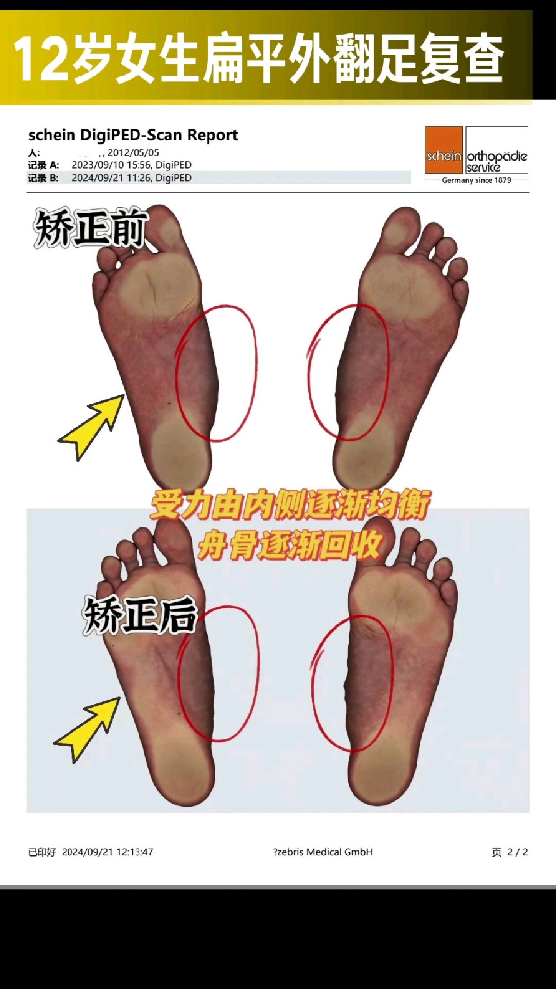 足外翻能治好吗