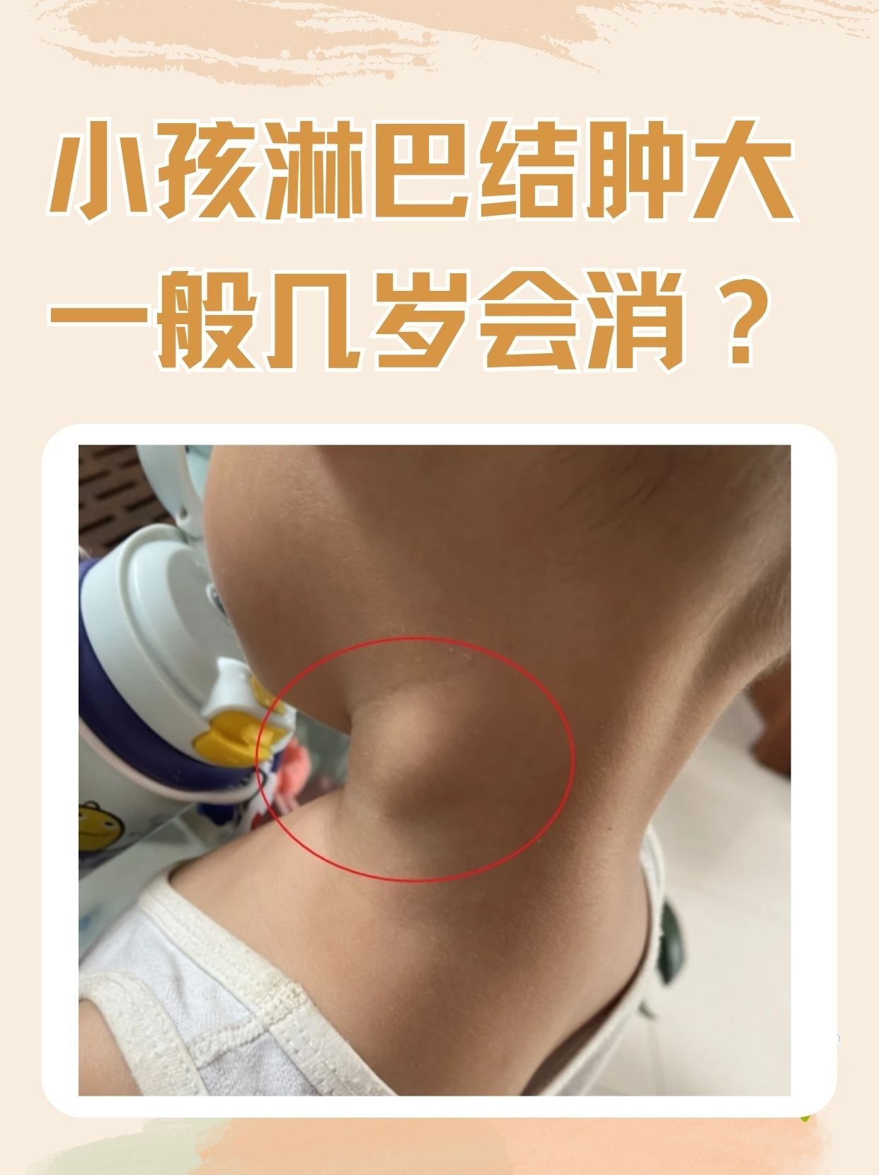 什么原因导致全身淋巴结肿大?