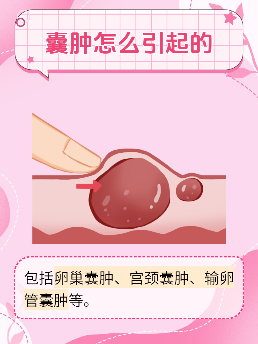囊肿是什么形成的怎么回事
